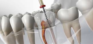 Facetas de porcelana