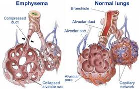 Pin On Emphysema