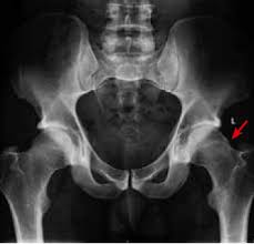 In fact, noncancerous bone tumors are much more common than cancerous ones. Racgp Hip Pain In Young Adults