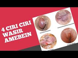 Gejala yang sering ditimbulkan bisa berupa timbulnya rasa gatal di sekitaran. Penanganan Wasir Berdarah Wasir Berdarah