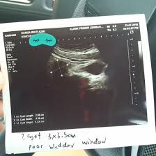 Mengecilkan perut hanya dalam seminggu? Kalau Sayang Rahim Tu Jangan Buat 8 Benda Ni Gadis Kongsi Pengalaman Kena Cyst 3 Kali