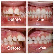 Pin On Dental Braces