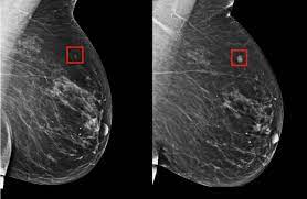 It can detect breast cancer, determine if it has spread, assess the effectiveness of a treatment plan and determine if the. Using Ai To Predict Breast Cancer And Personalize Care Mit News Massachusetts Institute Of Technology