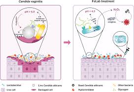 Image result for Vaginitis