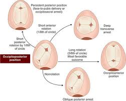Image result for Manual Rotation in Occipitoposterior Presentation