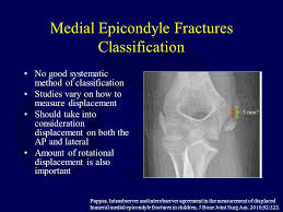 What's actually happening is a degeneration of the tendons that connect to your medial epicondyle. Fractures And Dislocations About The Elbow In The Pediatric Patient Ppt Download