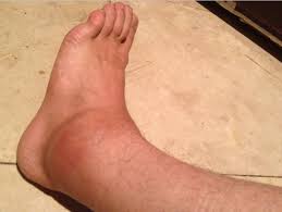 We did not find results for: Ankle Sprains Can Physio Help The Physio Lounge