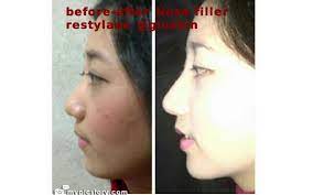 4,229 likes · 9 talking about this · 1,650 were here. Gloskin Bintaro Auf Twitter Hidung Mancung Dalam Sekejap Dengan Nose Filler Restylane Http T Co Etp0lx7gyu