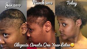 I will update my review after seeing if it truly makes my hair grow. I Grew My Bald Spots Back Using The Canvas Beauty Brand Youtube