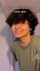 Dealing with Acne Insecurities: My Journey with T