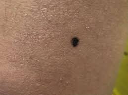 Skin cancer is the abnormal and uncontrolled growth of cells. Early Stage Melanoma Detected In Ground Breaking New Blood Test Wamn News Online