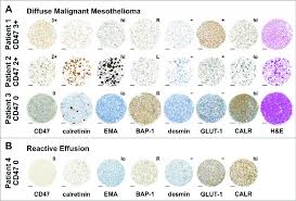 Cd47 Immunohistochemistry Discriminates Dmm From Reactive Mesothelial  Scientific Diagram