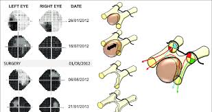 Image result for Visual Field Deficit