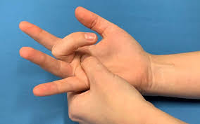 Educational image placeholder: tenderness at the base of the finger in trigger finger