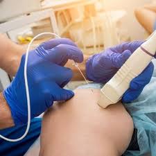 Image result for Radiofrequency Surgery