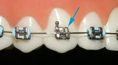 In case your wire ligature comes loose, take it out with a sterile tweezers. Orthodontic Emergencies What To Know And What To Do