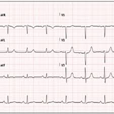 Acute Pericarditis and Cardiac Tamponade in a Patient with COVID-19: A  Therapeutic Challenge