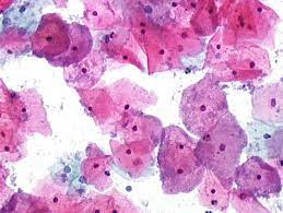 Histopathology and cytopathology of the uterine cervix - digital atlas - glossary