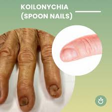 Image result for Koilonychia feet