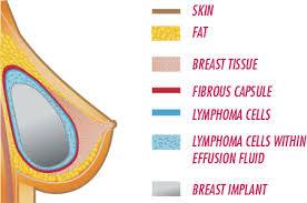 Breast tissue in both men and women also contain supportive fibrous tissue and fatty tissue. Breast Implant Associated Anaplastic Large Cell Lymphoma Bia Alcl Asps
