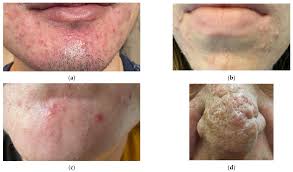 Image result for demodex rosacea