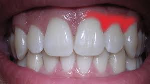 Mon secret pour avoir une belle peau sans bouton? 4 Bonnes Raisons D Utiliser L Huile De Coco En Bain De Bouche