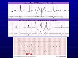 6th Part Ecg Basics Ventricular Arrhythmias Dr Salah Mabrouk Khallaf Raising funds for those in need through 350 op shops & our online store. 6th part ecg basics ventricular