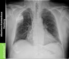 By sorin lazar, henry huang and erik wissner. Crt A Icd Pacemaker X Ray Doccheck