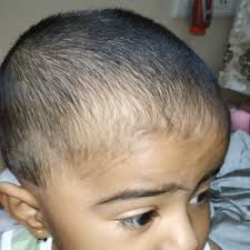 She said to cut them off. Parentingclinic Babyskincare Hi My Child Hairs Doesn T Grow Fast And He Has A Patch From Childhood On His Head Thats Ok But I Done His Hair Cut Recently And Seen Somewhere Hairs