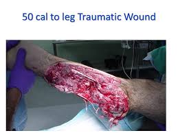 He explained the incident and shared photos of his wounds. Acute Wounds Lacerations Gsw S And Blasts Better Acute Wound Care Better Patient Outcomes Better Collaborations John P Kirby Md Facs Director Wound Ppt Download