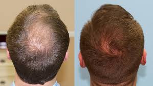It's pervasive and it may be due to stress, using the incorrect products, menopause and perimenopause hair loss. Crown Hair Loss Case Study Carolina Hair Surgery