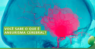 Un aneurisma cerebral es un ensanchamiento anormal en la pared de una arteria del cerebro. Quais Sao As Causas E Os Perigos De Um Aneurisma