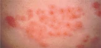 Gürtelrose äußert sich als hautausschlag & ist hoch ansteckend. Herpes Zoster Fur Alte Besonders Riskant