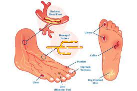 Check spelling or type a new query. Diabetic Foot Explained Ausmed