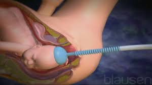 Image result for Forceps Assisted Delivery