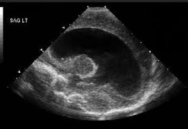 Periventricular Hemorrhage Intraventricular Hemorrhage Background Pathophysiology Epidemiology Ultrasound Physics Ultrasound Tech Preterm