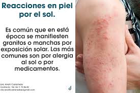 Dra Anahi Castaneda Zarraga Las Reacciones Al Sol Pueden Ser Por Consumo De Medicamentos O Por Sensibilidad Al Sol Suele Ser Hereditario Si Notas Cambios En Tu Piel Por El Sol