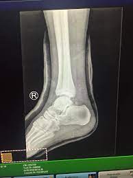 Maybe you would like to learn more about one of these? Imbasan Mri Sahkan Pemain Tajikistan Tidak Patah Tulang Kaki