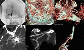 In questo caso alla valutazione di diagnostica per immagini tc o rm deve seguire una angiografia con possibilità di intervento endovascolare. La Dignostica Per Immagini Nella Pratica Clinica Tc Multidetettore
