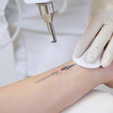 The area being treated the size of the tattoo Permanent Laser Tattoo Removal In Dubai Abu Dhabi Sharjah Men Women