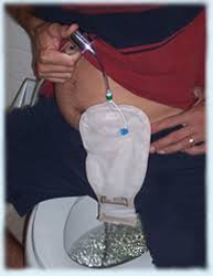 Ez Clean Ostomy Products Ostomy Ostomy Care Ileostomy