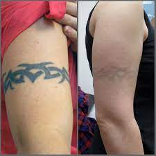 Yes i do agree with what you're saying giulia, only partially though, if you're not taking the precaution to make sure the tattoo artists work station is sanitized/sterilized, then you as a person deserve every bit of discomfort you have coming to. Can Tattoos Cause Cancer Reddit