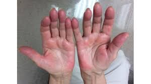 Demikian penjelasan yang dapat kami sampaikan seputar bintik berair di telapak tangan. Jangan Abaikan Telapak Tangan Yang Memerah Bisa Jadi Tanda Bahaya Lho Blog Tribunjualbeli Com