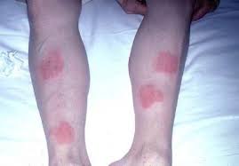 Allergic Reaction To Conducting Gel Used Under Ecg Electrodes