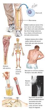 Symptoms in dogs may worsen, and the condition can. Bone Marrow Cancer Life Expectancy Cancerwalls