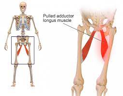 A groin strain is a tear of the adductor muscles on the inside of the thigh. Groin Strain Symptoms Treatment And Recovery