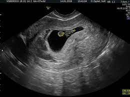 The scanning and display of ultrasound images are run at a sufficiently rapid rate so that moving structures can be viewed moving at their natural rate. Pregnancy Dating Scan From 8 Weeks Firstscan Window To The Womb