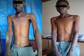 Pellagra is a deficiency disease caused by lack of the b complex vitamin niacin (b3, or nicotinic acid), either from a dietary lack of niacin and the essential amino acid tryptophan, or from an inability to properly absorb or metabolize niacin. An Outbreak Of Pellagra In The Kasese Catchment Area Dowa Malawi In The American Journal Of Tropical Medicine And Hygiene Volume 96 Issue 5 2017