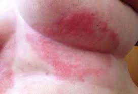 Image result for heat rash under breasts