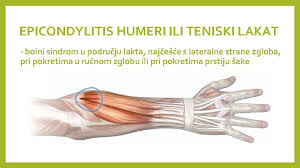 Možda će biti potrebne živčane studije za traženje začepljenja radijalnog živca u lakatnom. 12 Epicondylitis Humeri Ili Teniski Lakat Medicinska Kola